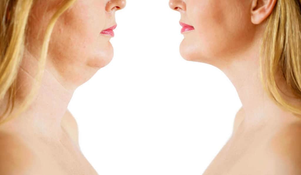 Double Chin treatment Kingsbury before and after results