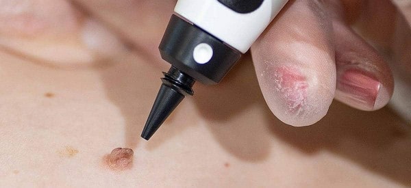 After Skin Tag Removal Kingsbury