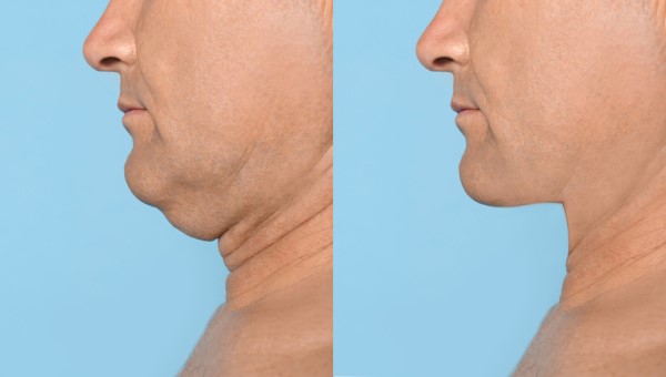 Which Non-Surgical Treatments Work Best for Jowls and Loose Skin Kingsbury?
