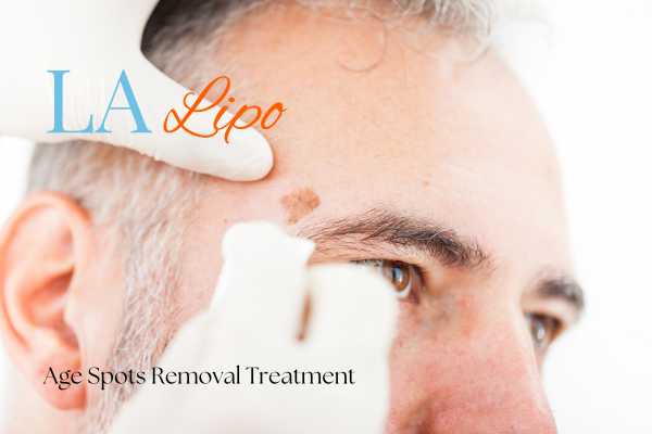 What Are the Most Effective Treatments for Age Spots Kingsbury?