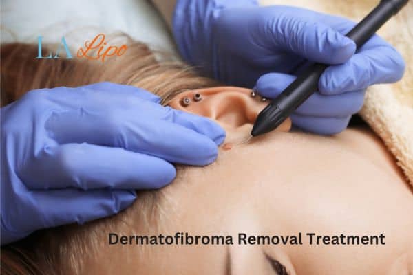 Dermatofibroma Removal Treatment Kingsbury