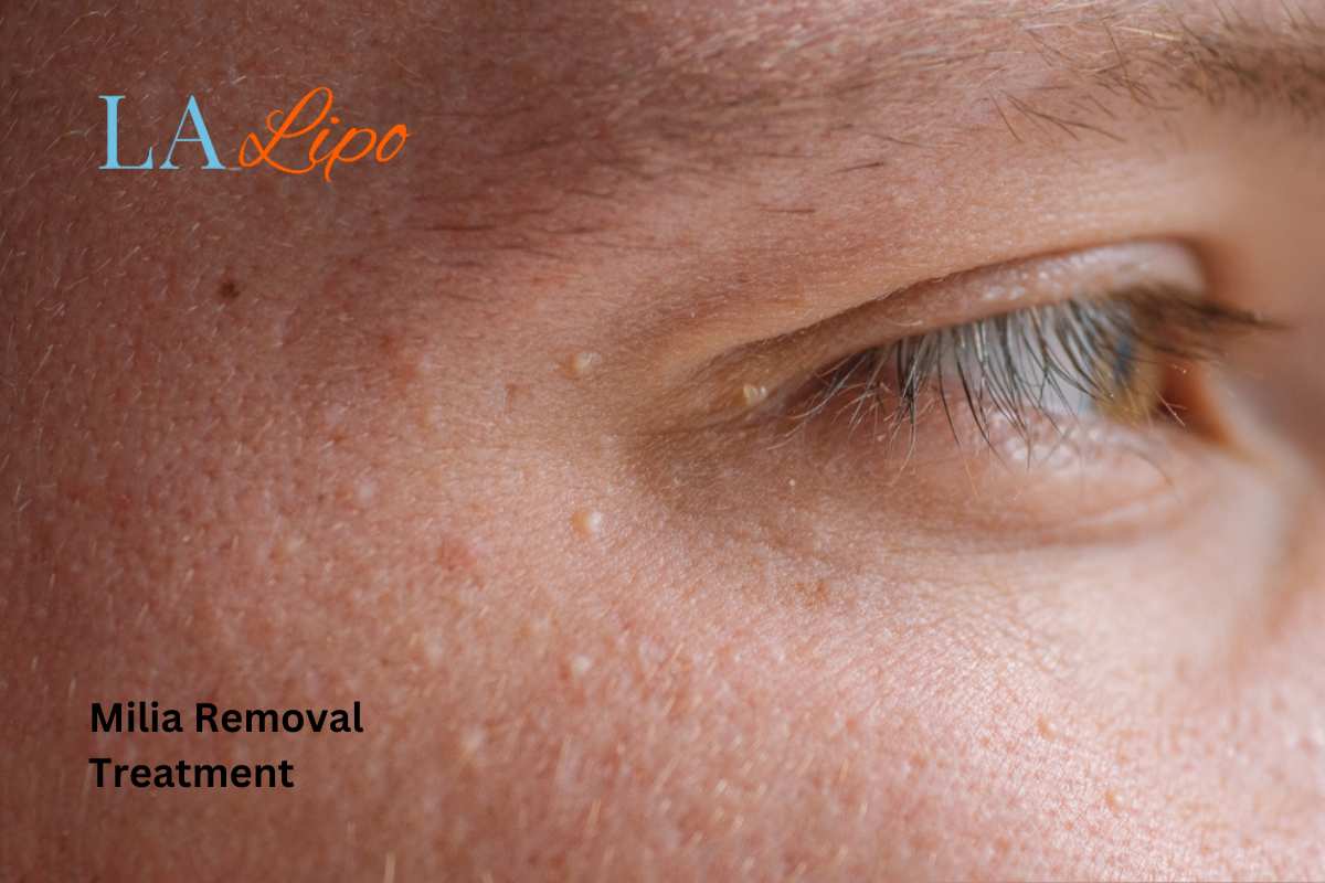 Cryopen Milia Removal: Is It the Easiest and Safest Option Kingsbury?