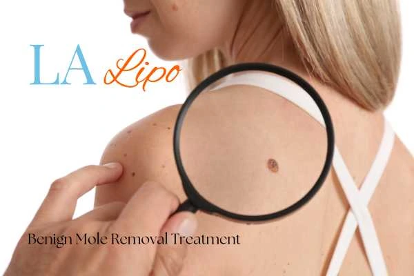 Woman having her inspection of blemish before mole removal Kingsbury