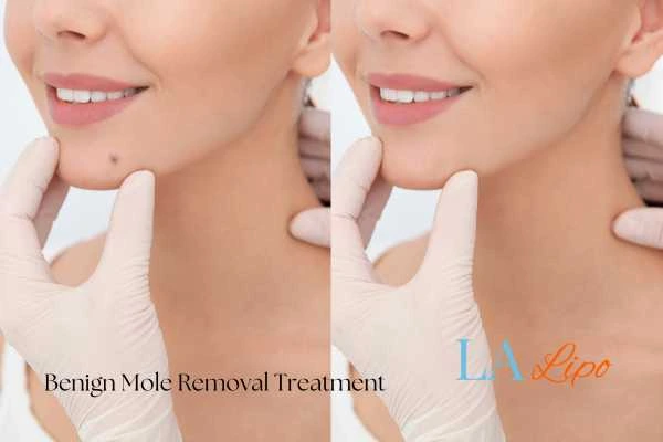 Before and after mole removal Kingsbury treatment