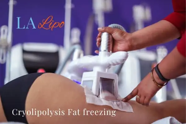 women getting fat freezing Kingsbury
