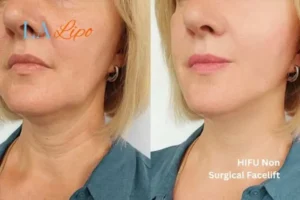 hi-fu for wrinkles Kingsbury before and after results
