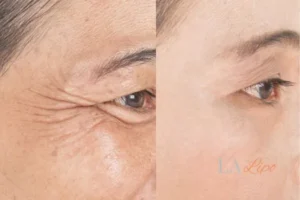 Before and after results of woman - HI-fu wrinkles reduction treatment Kingsbury