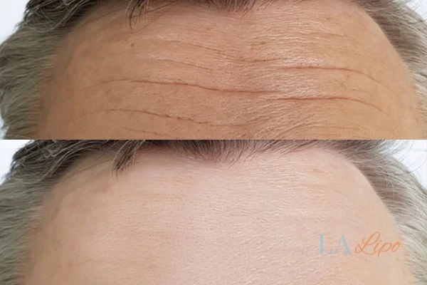 results of HIFU Kingsbury on mans forehead to help reduce lines and wrinkles