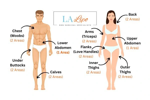 LA LIPO Cryolipolysis Areas Kingsbury