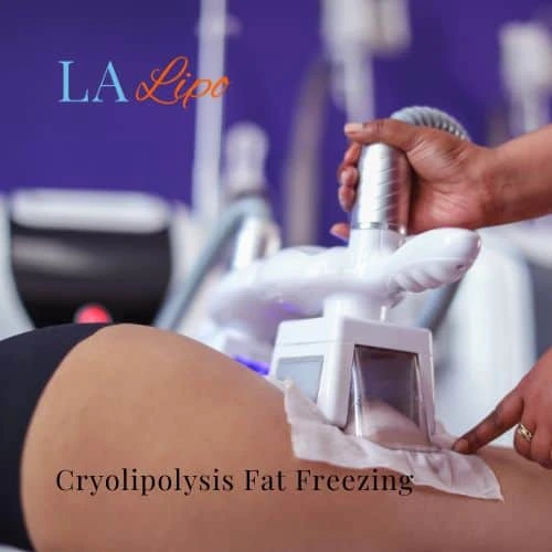 fat freezing - Cryolipolysis Kingsbury