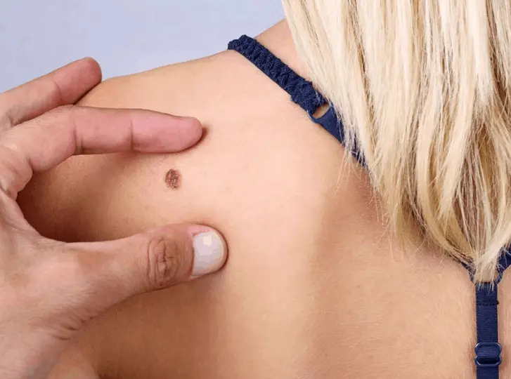 woman having mole removal Kingsbury consultation before treatment.