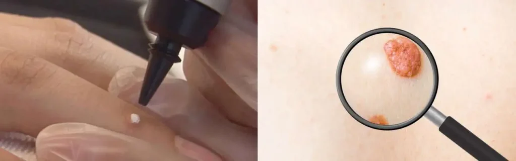 Cryopen for mole removal Kingsbury - speak to our team today!