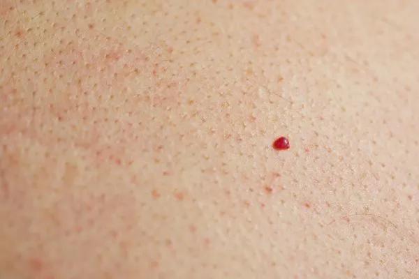 close up of a cherry angioma Kingsbury