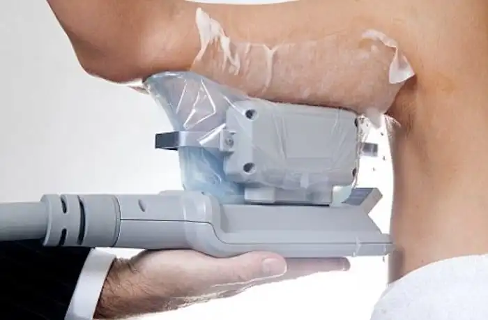 Picture of fat freezing Kingsbury on the upper arms.
