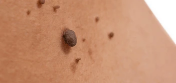 image of a skin tag Kingsbury