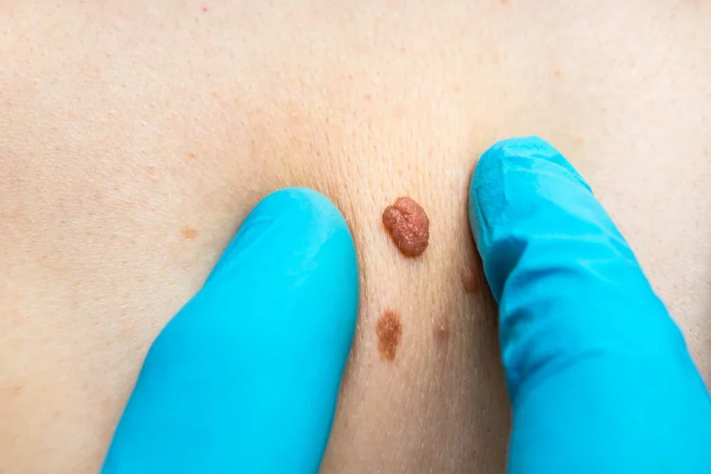 Consultant examining a skin tag Kingsbury