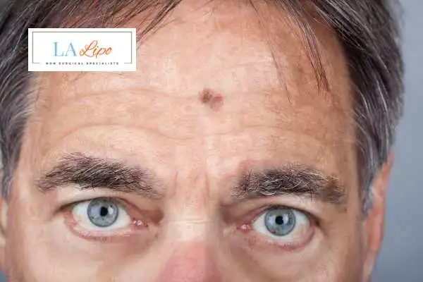 Solar Lentigo Removal Kingsbury image of man with mark on his forehead