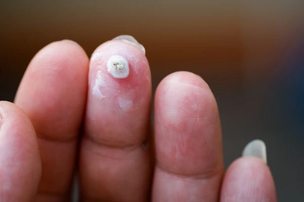 wart on person finger - cryotherapy to treat from LA LIPO Kingsbury