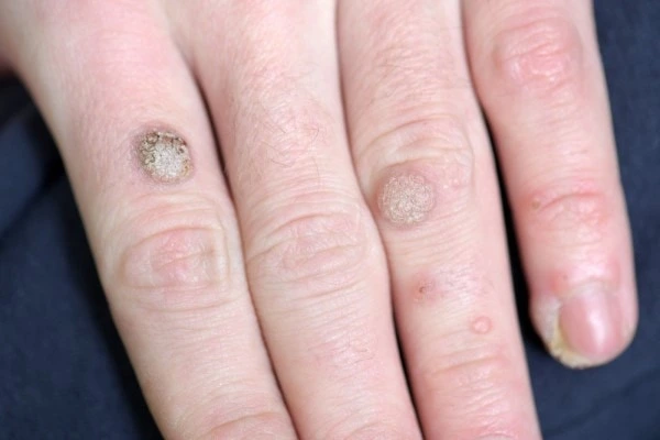 photo of warts on person hand - see wart removal Kingsbury from LA LIPO