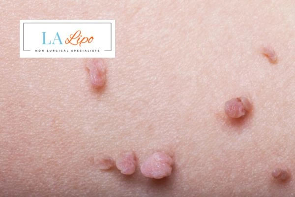 Does cryopen skin tag removal Kingsbury hurt? Find out now call our team today!
