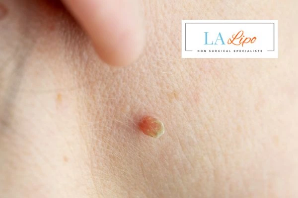 Book skin tag removal Kingsbury today speak to our team now!