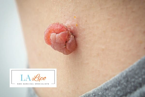 Interested in skin tag removal Kingsbury? Concerned about the pain? Find out more today!