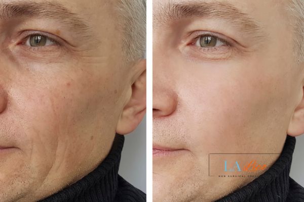 See the amazing results of Morpheus8 Treatment Kingsbury!