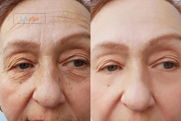 The powerful benefits of Morpheus8 Treatment Kingsbury - Call Our team today!