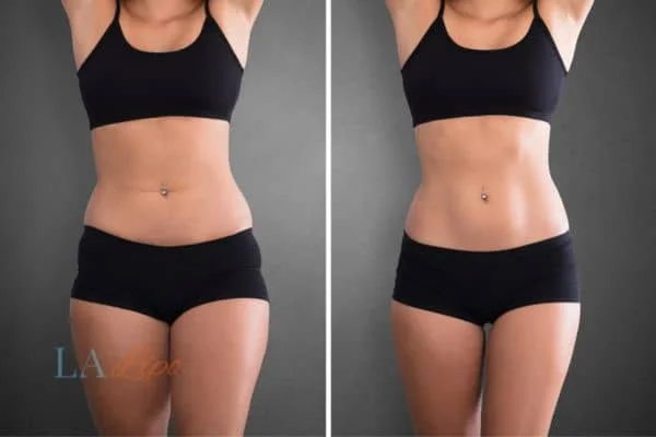 before and after results of non-surgical treatment to help a woman's body image and mental health Kingsbury