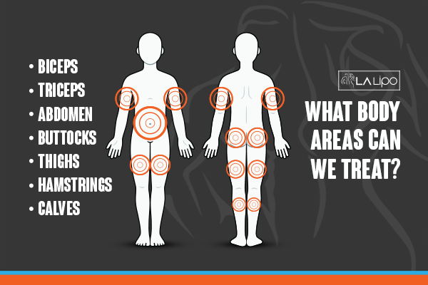 Diagram to show areas you can have LA-EMS Body Sculpting Treatment Kingsbury