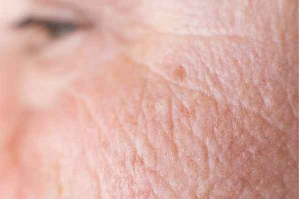 close up picture of a woman's face showing an age spot Kingsbury