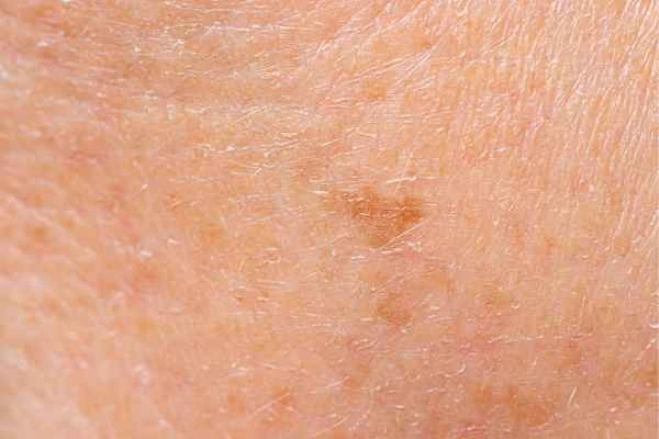 close up picture of age spots Kingsbury