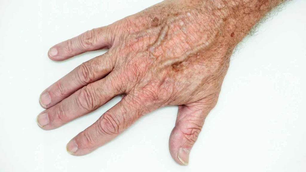 Male hand showing age spot Kingsbury