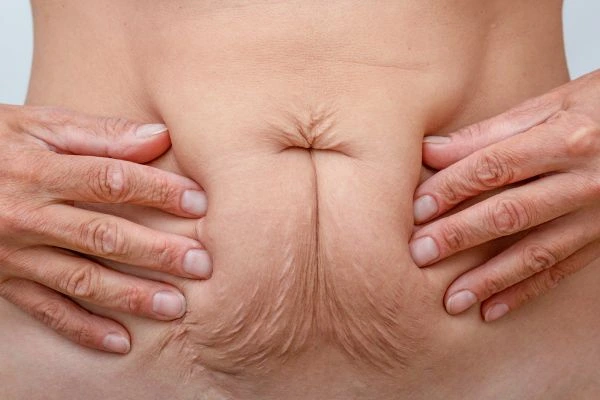 Image of a woman's stomach with loose skin - example of skin tightening Kingsbury options