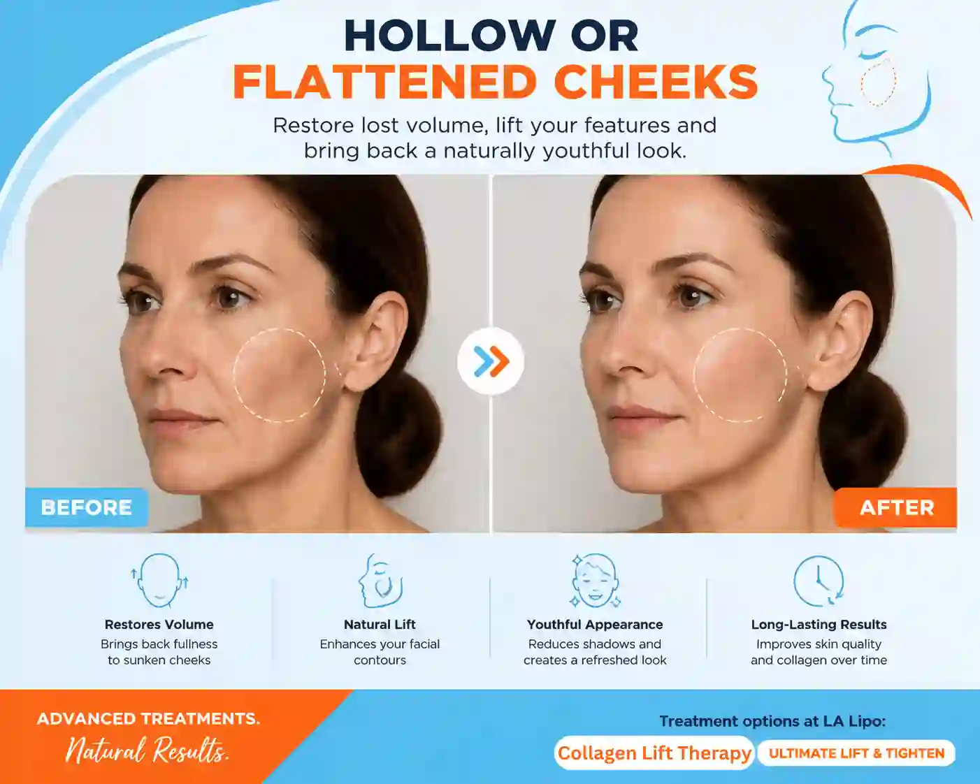 Sign #4: Hollow or Flattened Cheeks Kingsbury