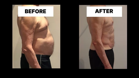 What Symptoms Can Diastasis Recti Cause in Men? Weak Core, Back Pain and Poor Posture Kingsbury